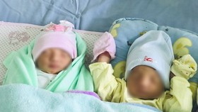 Twin with one in amniotic sac given birth in Vietnam