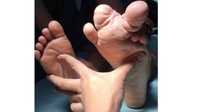 Bàn chân dị tật với 2 ngón chân khổng lồ trước phẫu thuật