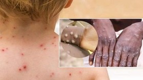 Lịch sử dịch tễ ca đậu mùa khỉ đầu tiên tại Việt Nam