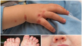 Dấu hiệu thường thấy khi trẻ mắc tay chân miệng
