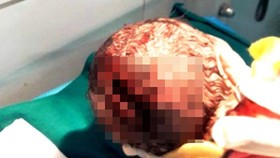 Kinh hoàng sản phụ tự sinh tại nhà, em bé bị rách toác đầu