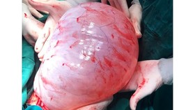 Thiếu nữ 22 tuổi “đốt ngải” để trị khối u buồng trứng gần 8 kg