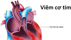 Viêm cơ tim có thể do nhiều loại virus, vi khuẩn gây ra