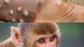 Đậu mùa khỉ lây từ người sang người qua quan hệ tình dục, lưu ý 3 thể bệnh