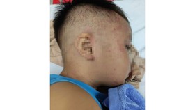 Cấp cứu kịp thời bé trai 4 tuổi bị bạo hành nhét vào tủ đông