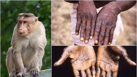 Khẩn trương xét nghiệm, cách ly ca nghi mắc đậu mùa khỉ ở Đắk Lắk
