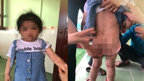 Khởi tố dì ruột dùng cán chổi đánh cháu gái 4 tuổi nhập viện