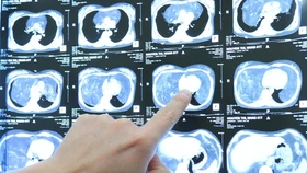 Cắt khối u khổng lồ hiếm gặp ở lồng ngực