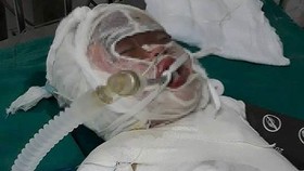 Cháu Linh bị bỏng nặng đang được cấp cứu ở bệnh viện