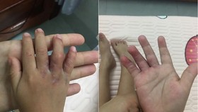 2 bàn tay sau phẫu thuật