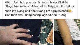 Mạng xã hội đăng lên nội dung về một cháu bé bị bầm tím 2 chân