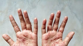 Các ban đỏ nổi trên tay một bệnh nhân mắc đậu mùa khỉ. Ảnh: Shutterstock/TTXVN