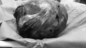 Phẫu thuật thành công khối u xơ tử cung nặng hơn 4kg 
