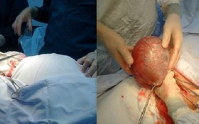 左圖：阮氏Ng.患者接收手術中。右圖：超大卵巢囊腫被成功摘除。（圖源：VTCNEWS）