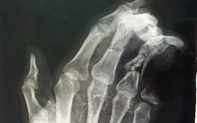 X-射線顯示傷者左手小指斷失了2節。（圖源：院方提供）