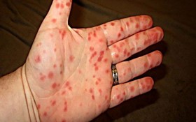皮膚出現紅斑就是登革熱病的特徵跡象。