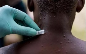  美國發現1名從尼日利亞返美的猴痘病毒病例。 （《紐約時報》報導截圖）