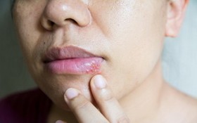 嘴唇長小水泡是唇皰疹還是口角炎？