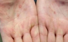 猴痘的病變常常出現在手掌上。