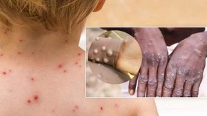 MoH takes action after first monkeypox case recorded in Vietnam