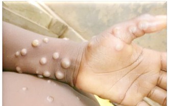 猴痘感染人後的癥狀表現。