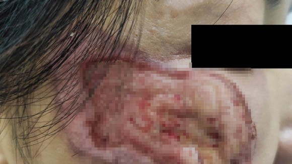 Vùng da bị lở loét, mưng mủ sau khi sử dụng thuốc không có nguồn gốc
