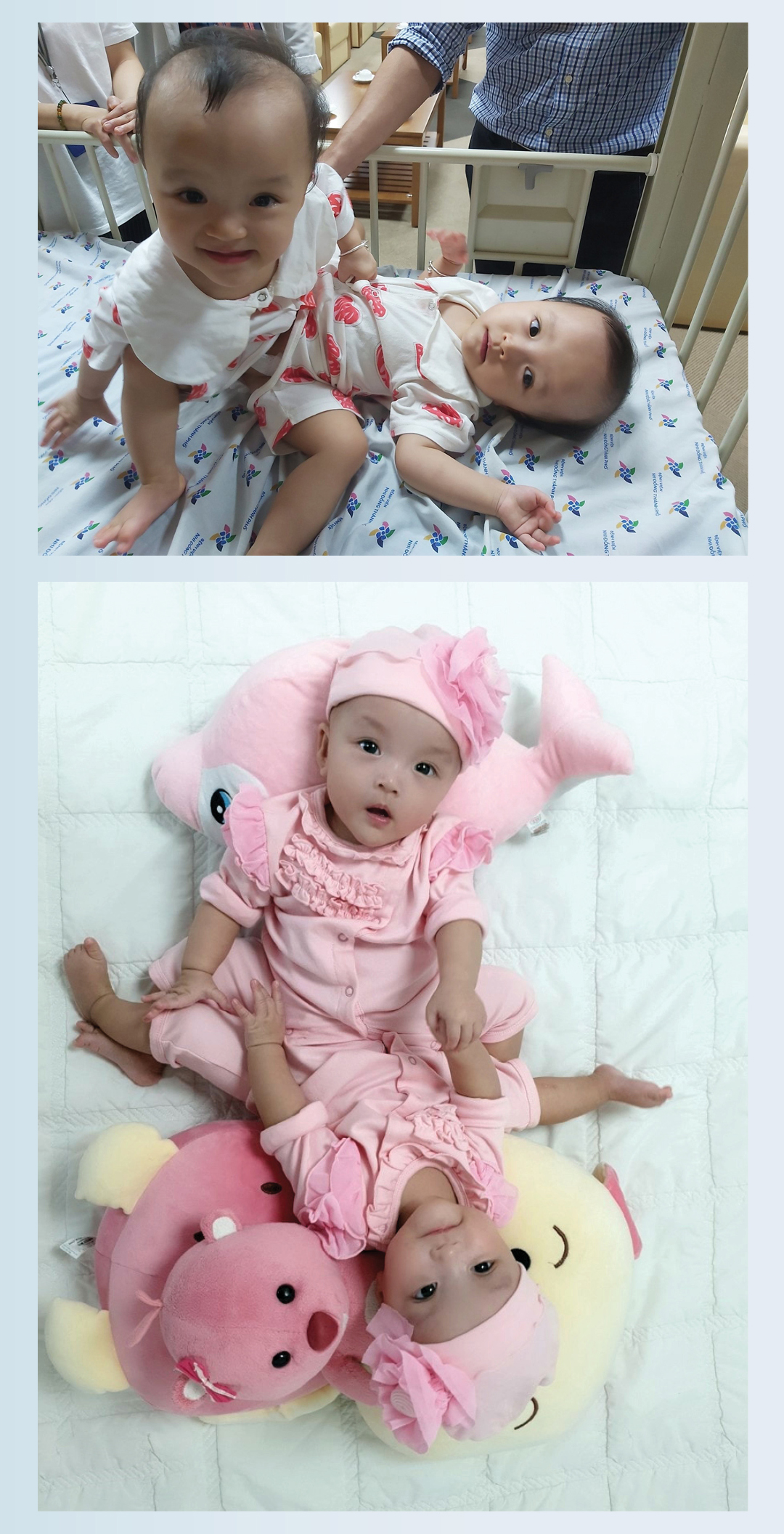 Hành trình của cặp song sinh dính liền hiếm gặp nhất Việt Nam Diệu Nhi - Trúc Nhi ảnh 3