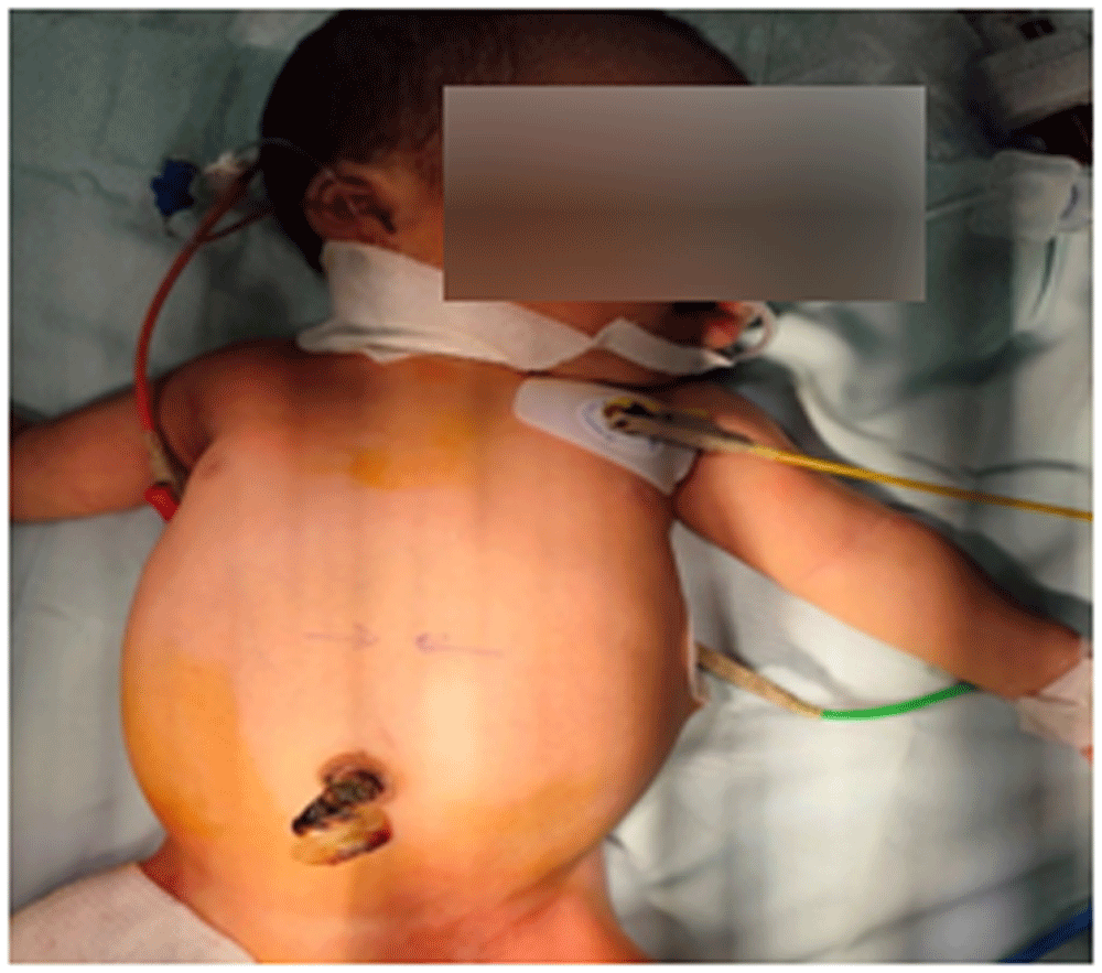 Phẫu thuật thành công cho bé trai 13 ngày tuổi mắc “thai trong thai” ảnh 1