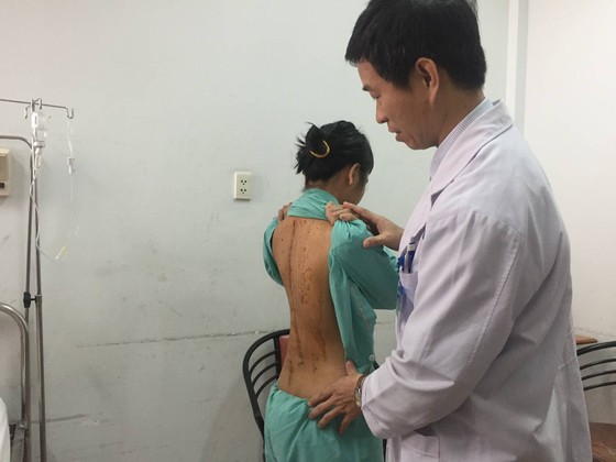 Phẫu thuật thành công cột sống nữ sinh bị cong đến 110 độ ảnh 1