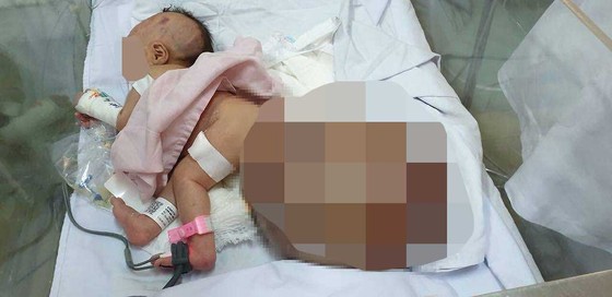 Bé sơ sinh 1 ngày tuổi mang khối bướu nặng 3,1kg ảnh 1