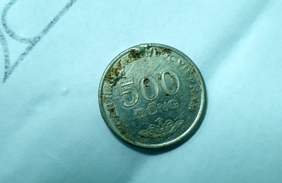 Gắp thành công đồng xu trong người bé gái 6 tuổi ảnh 1