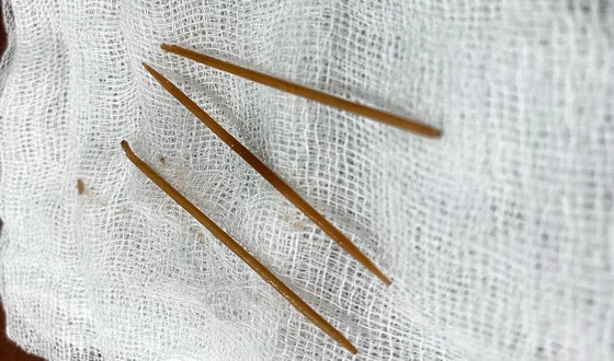 Ngủ quên, nuốt 3 cây tăm tre vào bụng ảnh 2