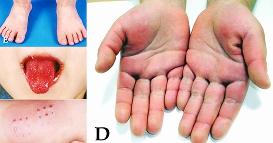 WHO điều tra hội chứng viêm hiếm gặp nghi liên quan Covid-19 ảnh 1