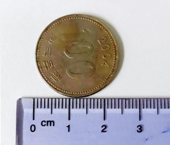 Gắp đồng xu hơn 2cm ra khỏi thực quản bé gái 9 tuổi ảnh 1