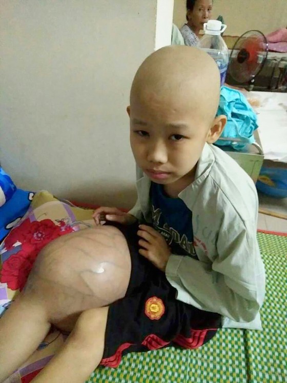 Bé bị ung thư xương, chân sưng to ảnh 1