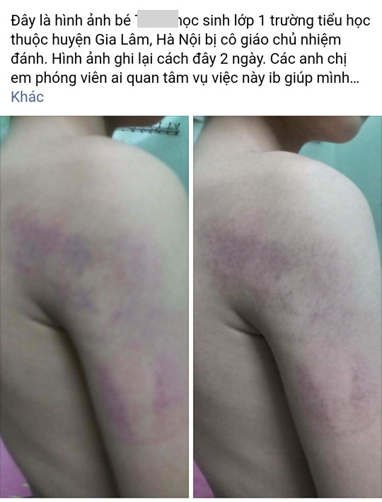 Cô giáo tại Hà Nội đánh học sinh lớp 1 bầm tím cánh tay ảnh 2