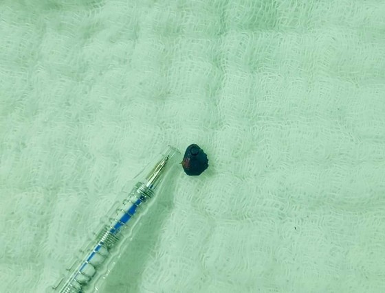 Học sinh lớp 1 bị một nhóm học sinh cùng trường nhét đất sét vào tai ảnh 2