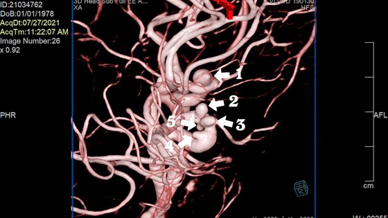 Điều trị thành công bệnh nhân có 5 túi phình mạch máu ảnh 1