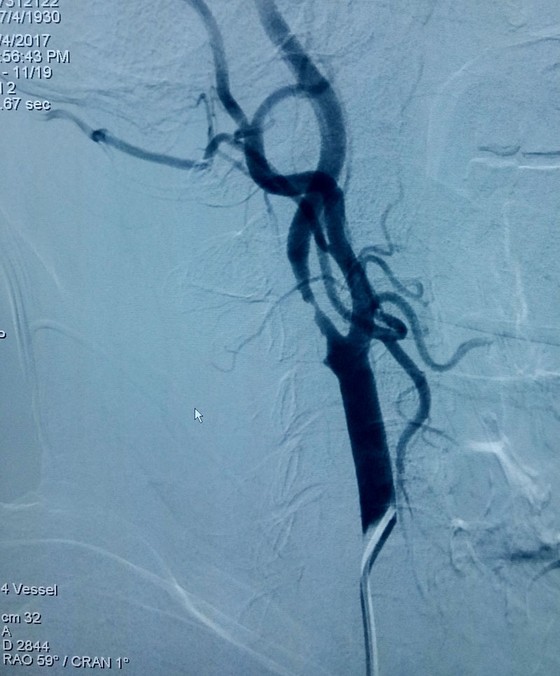 Lần đầu tiên đặt stent điều trị bệnh hẹp động mạch cảnh tại bệnh viện tuyến quận ảnh 1