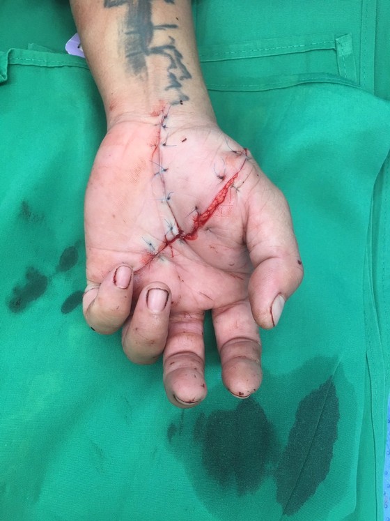 Nối bàn tay bị đứt lìa ngay trong đêm cho bệnh nhân ảnh 1