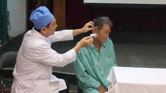 Gắp cây tăm nhang nằm sâu trong lỗ rò luân nhĩ ảnh 1