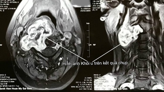 Giúp bệnh nhân bỏ u bao dây thần kinh cột sống cổ xâm lấn ảnh 1