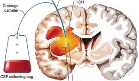 Ứng dụng kỹ thuật công nghệ cao định vị 3 chiều Navigation trong phẫu thuật xuất huyết trong não ảnh 2