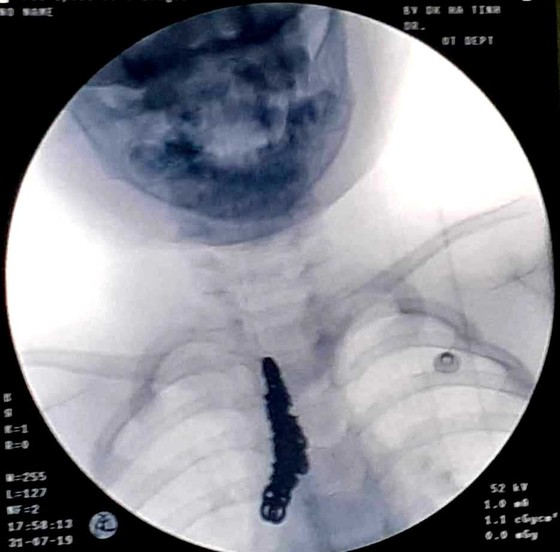 Gắp sợi dây chuyền bạc dài 14cm trong khí phế quản của bệnh nhi 28 tháng tuổi ảnh 1