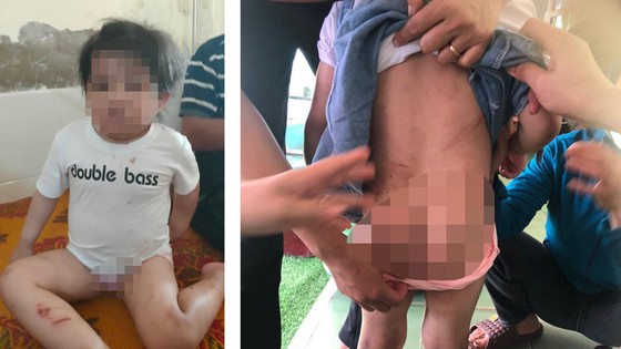 Hà Tĩnh: Một bé gái nhập viện nghi bị đánh ảnh 1
