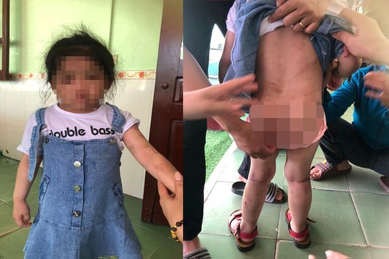 Khởi tố dì ruột dùng cán chổi đánh cháu gái 4 tuổi nhập viện ảnh 2