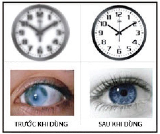 Tìm lại ánh sáng cho người trung niên và cao tuổi ảnh 1