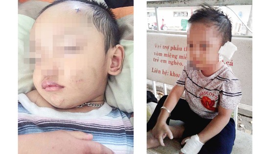 Bé trai 3 tuổi ở Bình Dương nghi bị mẹ ruột và cha dượng bạo hành ảnh 3