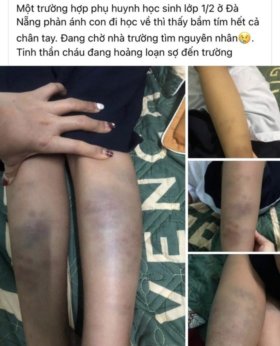 Đà Nẵng: Thực hư vụ học sinh bị đánh bầm tím  ảnh 1