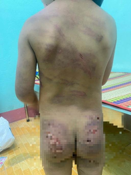 Bé gái 7 tuổi tại Bình Phước nghi bị bạo hành ảnh 1